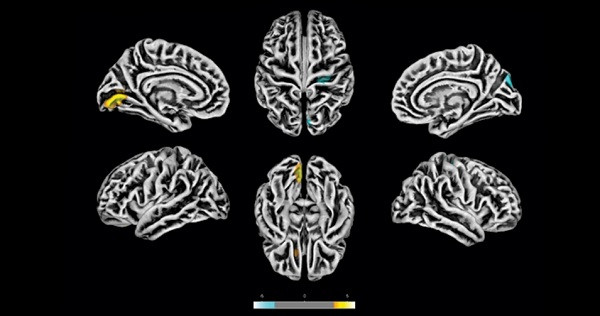 Exames de ressonância magnética feitos na Unicamp em 81 pacientes com sintomas neuropsiquiátricos pós-COVID revelam alterações na estrutura do córtex cerebral. As áreas em amarelo apresentam redução na espessura cortical. As marcas azuis correspondem a áreas com espessura aumentada. Foto: Divulgação/Fapesp